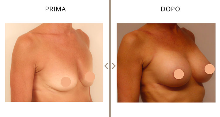 Mastoplastica Additiva