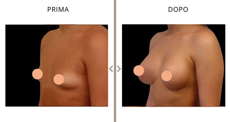 Mastoplastica Additiva