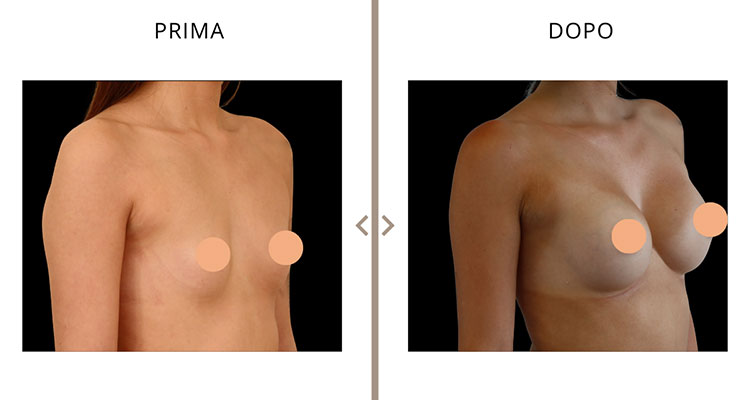 Mastoplastica Additiva