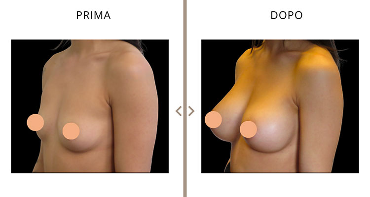 Mastoplastica Additiva