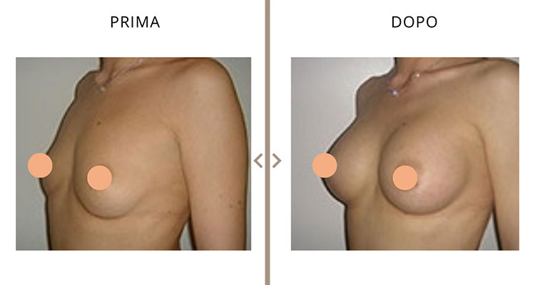 Mastoplastica Additiva