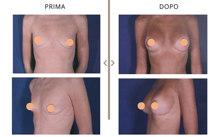 Mastoplastica Additiva