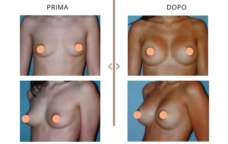 Mastoplastica Additiva