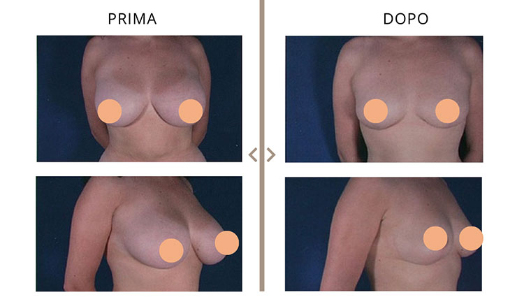 Mastoplastica Riduttiva