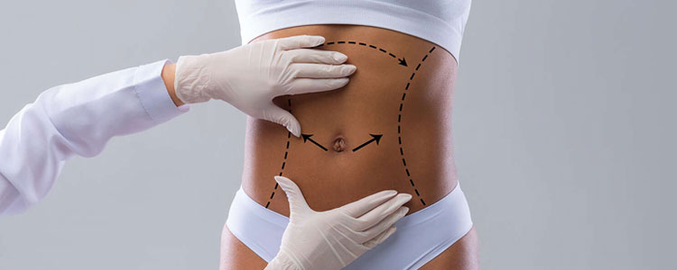 Abdominoplasty