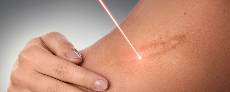 Fractional Laser